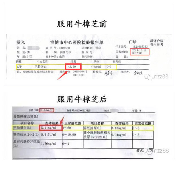 牛樟芝与肝癌 肝硬化 肝腹水 乙肝